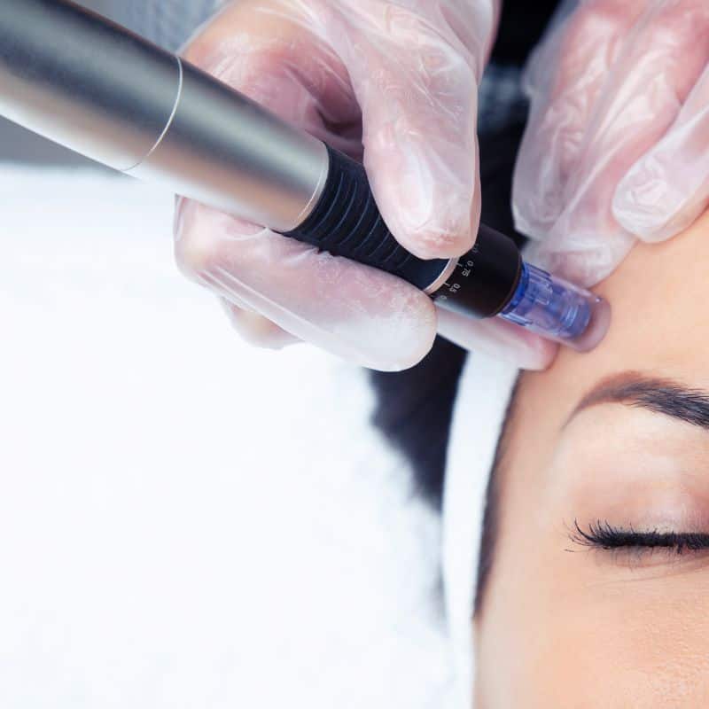 Morpheus8 treatment Walsall from Lipo Sculpt - Book in today!