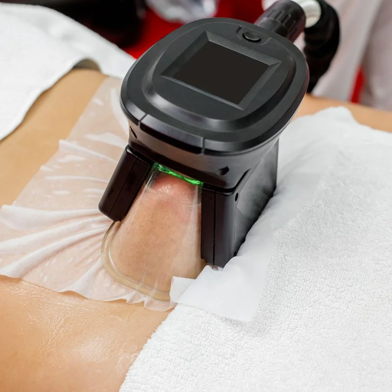 Fat Freezing treatment Walsall